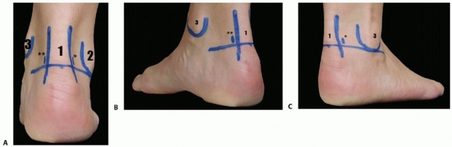 Illustration 5 for Posterior Talar Process: Endoscopic Solutions for Ankle Pain