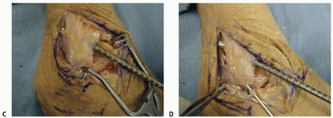 Illustration 12 for Lateral Ankle Repair: Maximize Stability with Interference Screw Fixation