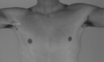 Pectoralis Major Muscle Injuries: Causes, Symptoms & Treatment