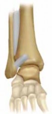 Illustration 3 for Optimal Fixation of the Ankle: Open Reduction & Internal Fixation