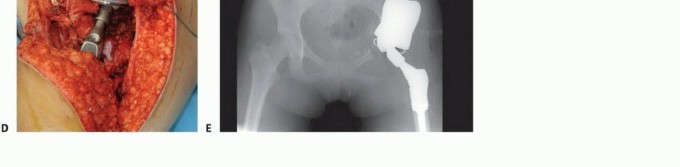 Illustration 11 for Distal Femoral Replacement: Key to Modern Limb Salvage