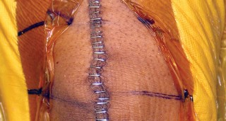 Illustration 17 for Monoblock Total Knee: When to Use & What to Avoid