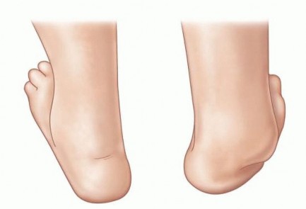 Illustration 6 for Why Anterior Tibialis Muscle Transfer Fixes Clubfoot