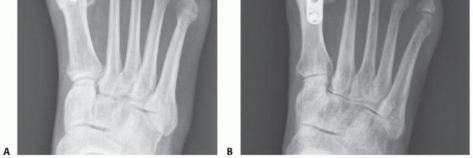 Illustration 74 for End Articular Cartilage Loss: Arthrosurface HemiCAP Resurfacing