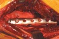 Illustration 32 for Optimal Fixation of the Ankle: Open Reduction & Internal Fixation