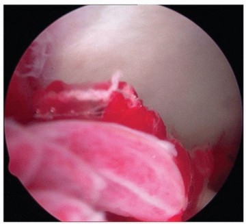 Illustration 11 for Hip Pain Relief: Arthroscopy for Nonstructural Pathology