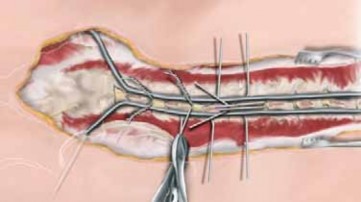 Illustration 18 for Optimizing Instrumentation for Neuromuscular Scoliosis