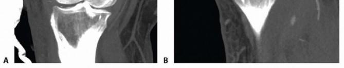 Illustration 9 for Repairing Distal Femur Fractures: Open Reduction & Internal Fixation