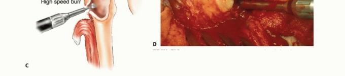 Illustration 15 for Mastering Femoral Metastases: Optimal Function for Femoris & Vastus