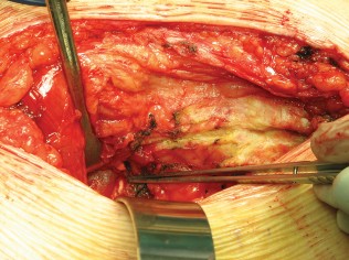 Illustration 26 for Figure Hip Resurfacing: Who Benefits and Who Should Avoid It?