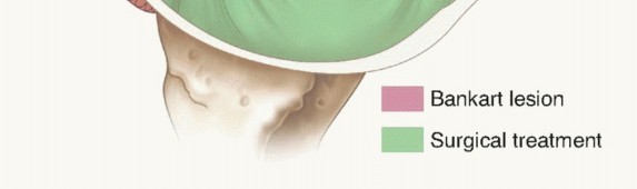 Illustration 9 for Regain Stability: Arthroscopy for Anterior Instability & the Inferior Glenohumeral Ligament