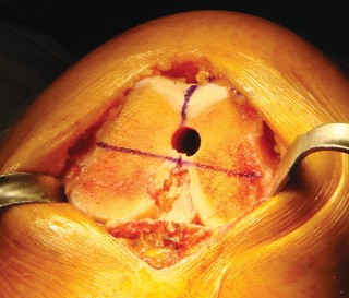 Illustration 17 for Cemented TKA Figure: Your Visual Guide to Surgical Success