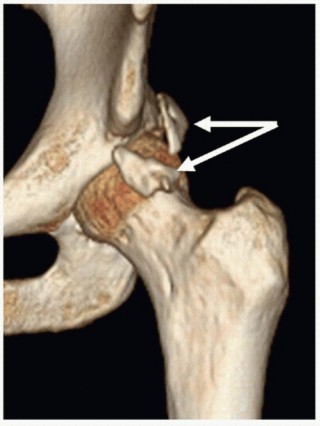 Illustration 38 for Beyond Knee Surg: Hip Arthroscopy for Sports Injuries