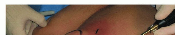 Illustration 24 for Is Your Dorsal Scapular Nerve Causing Snapping Scapula Pain?