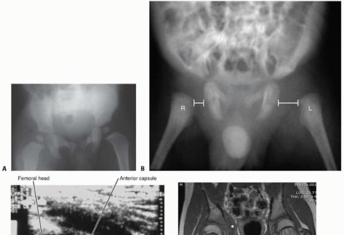 Illustration 4 for Septic Hip in Children: Mastering Anterior Drainage for Optimal Recovery