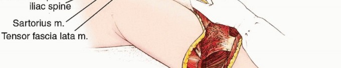 Illustration 18 for Anterior Flap Hemipelvectomy: Leveraging fig tech fig for Difficult Tumors