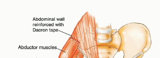 Illustration 24 for Surgical Pelvic Resection: Gluteus Maximus Muscle & Nerve Preservation