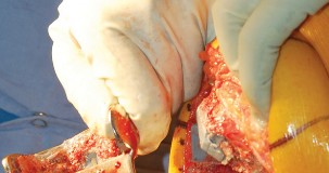 Illustration 32 for Mastering Gap Balancing in Revision TKA: Avoid Common Pitfalls