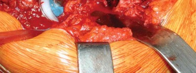 Illustration 54 for S-ROM: Inside the Technique of Modular Implant Design