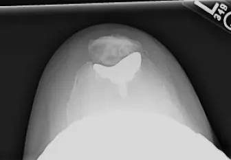 صورة توضيحية لـ جراحة استبدال المفاصل الكلي: دليلك الشامل لتصميمات الأطراف الصناعية، الميكانيكا الحيوية، ودواعي الاستخدام مع الأستاذ الدكتور محمد هطيف