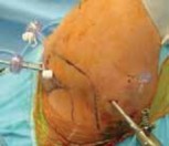 Illustration 30 for Regain Stability: Anterior Shoulder Instability Arthroscopic Fix