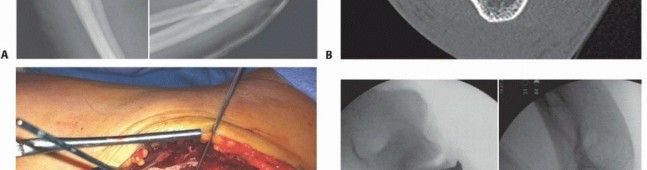 Illustration 5 for Restore Stability & Motion: Fixation of Fracture-Dislocations