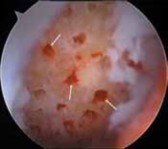 Illustration 18 for Microfracture Chondroplasty: How Tiny Holes Are Made to Fix Cartilage