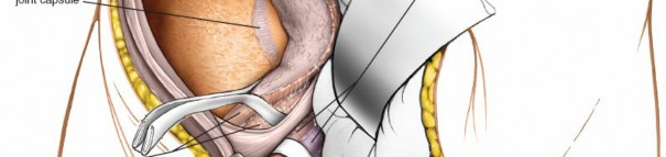 Illustration 24 for Ilioinguinal Approach: Master the Deep Inguinal Ring for Success