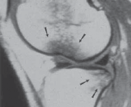 Illustration 3 for Optimizing Single-Bundle Anterior Cruciate Ligament Repair