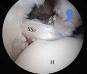 Illustration 35 for Arthroscopic Subscapularis Repair: The lo iky brady Method for Stability