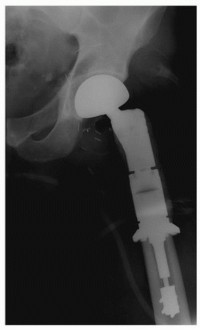 Illustration 37 for Allograft Prosthetic Composite: Mastering Proximal Femur Reconstruction