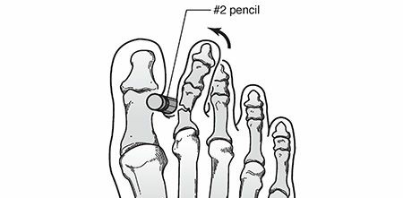 Illustration 25 for Mastering First MTP Joint & Forefoot Fractures: A Comprehensive Guide