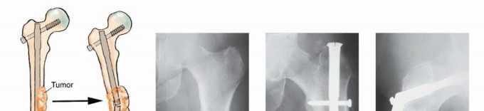 Illustration 25 for Plain Radiograph Showing MBD: Surgical Planning to Prevent Failures