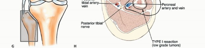 Illustration 13 for Beyond Amputation: The Type I Resection in Fibular Tumor Surgery