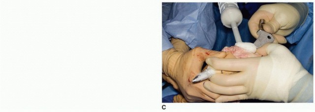 Illustration 19 for Allograft Prosthetic Composite: Mastering Proximal Femur Reconstruction