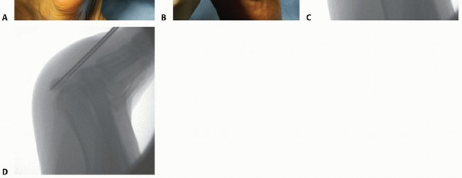 Illustration 13 for Optimizing Internal Fixation of Sesamoid Fractures