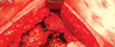 Illustration 8 for Posterolateral Surgical Approaches: Achieve Optimal Hip Replacement