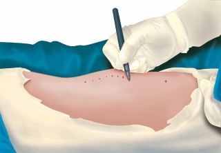 Illustration 12 for Mastering Gap Balancing in Revision TKA: Avoid Common Pitfalls