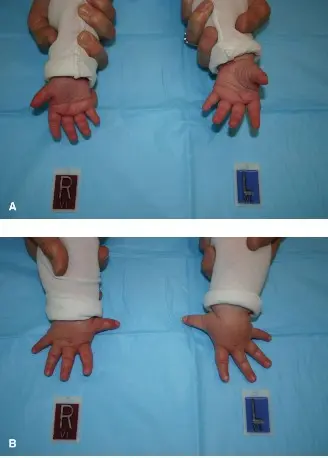 صورة توضيحية لـ الإبهام ناقص التنسج: دليل شامل للآباء حول تصنيف بلاوث، التشريح، العلاج وإعادة التأهيل