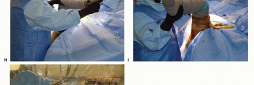 Illustration 25 for Anterior FAI Relief: Mini-Open Anterior Approach Explained