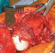 Illustration 34 for Advanced Arthroplasty for Malignant Lesions: Reclaim Your Mobility