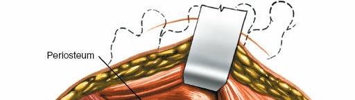 Illustration 296 for Approach to the Lumbar Spine: Mastering Techniques & Anatomy