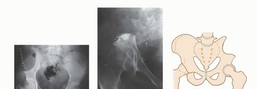 Illustration 14 for Surgical Pelvic Resection: Gluteus Maximus Muscle & Nerve Preservation