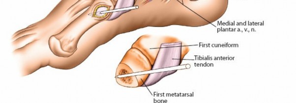 Illustration 41 for Key Approaches for External Fixation: Humerus, Radius, Ulna, Wrist