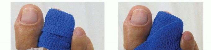 Illustration 44 for Plantar Plate Repair: End Lesser Toe Pain & Instability