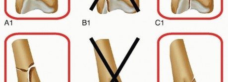 Illustration 10 for Retrograde Femoral Nailing: Optimizing Surgical Outcomes