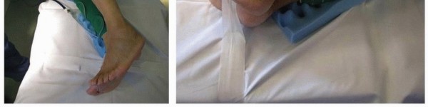 Illustration 6 for Extended Trochanteric Osteotomy: How et al Extended Revision THA Solutions