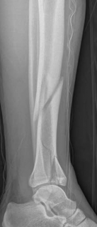 Illustration 2 for Complex Tibial Shaft Fracture: Plate Fixation for Plafond Extension