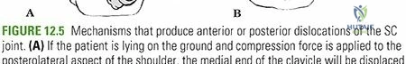 Illustration of joint injury sternoclavicular - Dr. Mohammed Hutaif