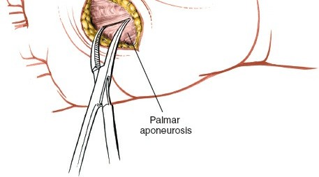 Image of pre-operative imaging for hand infection
